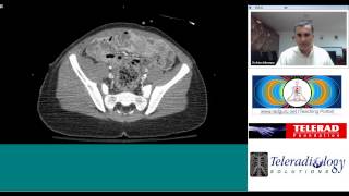 Pancreatic Laceration CT Scan Video by Dr. Arjun Kalyanpur