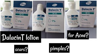 Dalacin T lotion Review ||Acne ||pimples &scars