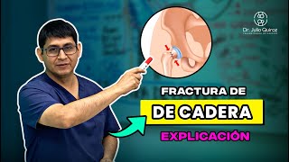 TIPOS DE FRACTURA DE CADERA  - intracapsular vs extracapsular