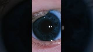 eyelid coloboma