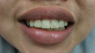 Tambal Gigi Sebelum Dan Sesudah | Dental Edukasi