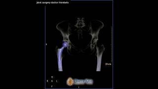 Hip arthroplasty 3d- doctor Horobets