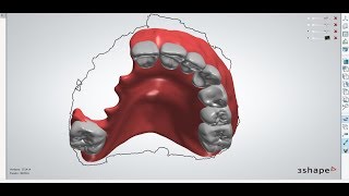 MODEL-LESS, digital, acrylic, non-metal clasps, removable partial denture.