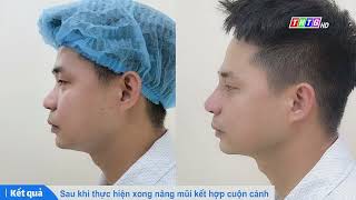 Nâng Mũi Cho Nam Giới - Chia Sẻ Từ Bác Sĩ Lê Văn Vĩnh Trên Truyền Hình Tiền Giang