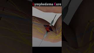 Lymphedema  cure #shorts