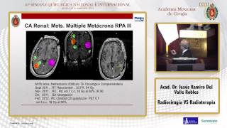Radiocirugía VS Radioterapia - Acad. Dr. Jesús Ramiro Del Valle Robles - 24/09/14