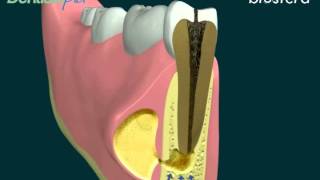 Ascesso: la terapia endodontica