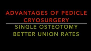 Pedicle  Cryosurgery or Cryotherapy or Liquid Nitrogen surgery of Distal Tibia or Leg Bone sarcoma