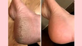 Nakakalambot ng Paa||jelly foot Spa | ang mura talaga 10 pesos only