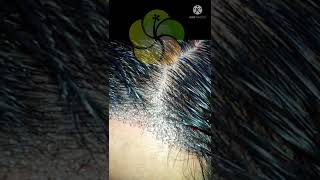 Hair Transplant | Hair Transplant Without Shaving | Niramoy Speciality Clinic