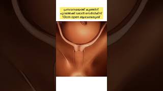 Normal deivery നടക്കാൻ cervix 10 cm open ആവേണ്ടതുണ്ട്💯🤰#baby #pregnantwoman #malayalam #preggy