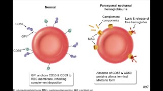 Paroxysmal nocturnal hemoglobinuria