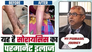 Psoriasis Recovery | बच्चू सिंह का सोरायसिस हुआ 100% बिल्कुल ठीक सिर्फ भारत होमियोपैथी से