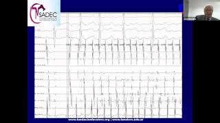 Simposio Webinar "Fibrilación Auricular en Argentina"