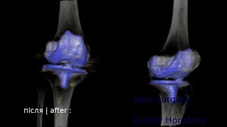 Заміна колінних суглобів до та після операції (censored) Knee arthroplasty before and after surgery