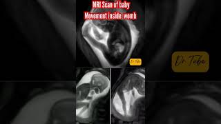 REAL MRI scan of baby kicking inside womb | गर्भ के अंदर बच्चा कैसा हलचल करता है #ultrasound #baby