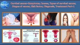 Cervical cancer Symptoms, Causes, Types , Stages of cancer, Risk factor, Diagnosis,Treatment Part-1