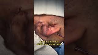 Reconstrução de orelha ( neo- otoplastia) para microtia.