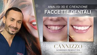 Analisi 3D e Creazione Faccette Estetiche