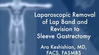 Lap Band Removal and Revision to Sleeve Gastrectomy