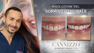 Cannizzo Studio | Risoluzione del Sorriso Gengivale