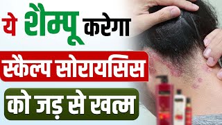 Best Shampoo For Scalp Psoriasis In India | Best Shampoo For Psoriasis | Psoriasis Care