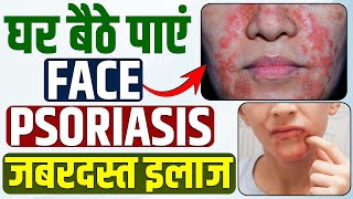 🏠 Home Remedies for Face Psoriasis | फेस सोरायसिस को कैसे ठीक करें | Face Psoriasis Ka Gharelu Ilaj