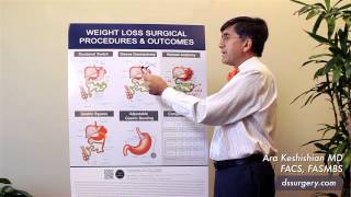 Weight Loss Surgical Procedures Part 2- Sleeve Gastrectomy