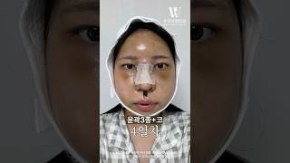 안면윤곽3종+코 후기 #shorts #plasticsurgeryinkorea