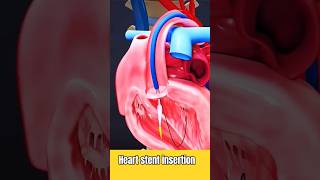 #heartstent #stents #heartanimation #heartvideo #mbbsdreams #shortvideo #anatomy #medicalanimation