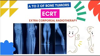 ECRT Extra corporeal radiotherapy for Bone Tumors Osteosarcoma Tibia or Leg Diaphysis area