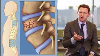 Dr. Samuel Bederman, Kyphoplasty Procedure, RESTORE Orthopedics and Spine Center