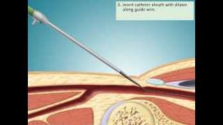 Cardiac Catheterization via Femoral Artery