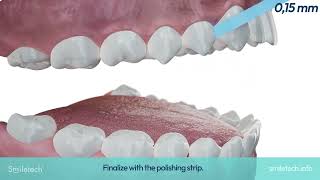 "Smiletech Interproximal Reduction (IPR/Stripping) in Invisible Orthodontics - ENG"