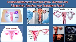 Complications with ovarian cysts, Ovarian Cyst Diagnoses, Ovarian cyst Treatment Part 3