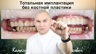 Случай из практики, тотальная имплантация без костной пластики.