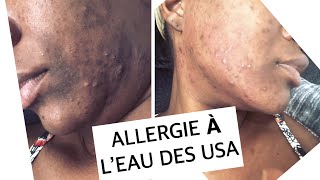 ALLERGIE À L’EAU DES USA//COMMENT JE GÈRE MON ACNÉ // MA ROUTINE FACIALE SPÉCIALE ACNÉ