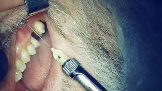 Infiltration anesthesia technique for implantation missing 2.6 teeth.