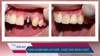 IMPLANT CÔNG NGHỆ MỚI