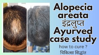 How to cure Alopecia areata ?#ayurvedic #hairtreatment #ayurveda