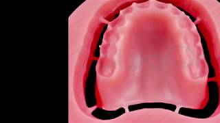 Digital denture CAM strategies.