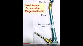 Growing Joint or Expandable Joint Surgery : Total Femur Replacement Surgery with a  Megaprosthesis