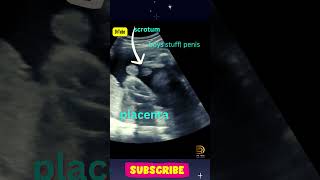 Ultrasound Showing Baby Boy 👶 | Gender Reveal #shortsfeed