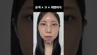 울퉁불퉁 광대 싹 없애버리기 #shorts