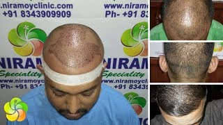 Hair Transplant Video | Cheap and Affordable | Kolkata,Dhanbad,Howrah