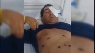 Tucumán: perdió un ojo por un disparo policial