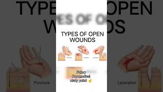 TYPES OF OPEN WOUNDS