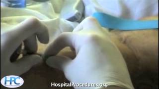 Ultrasound Guided Peripheral IV video