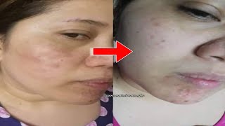 APIRIN MASK PEKAS & MELASMA SOLUTION HOW WATCH THIS