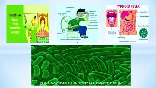 Typhoid|causes of typhoid|best cure for typhoid| starting stage of typhoid #typhoid #foresightlearn